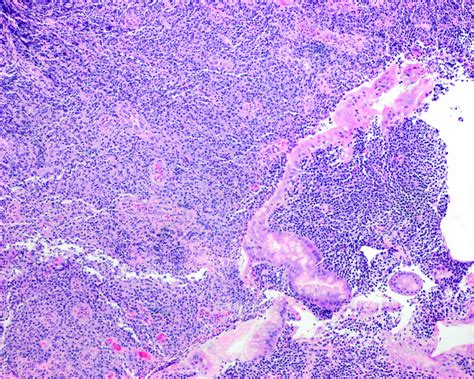 lymphoma in the stomach labelled.